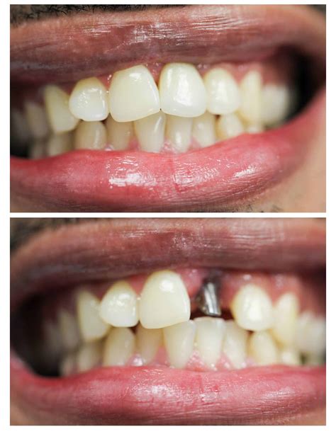 Dental Implants NYC | Manhattan Dentist | Best Dentist