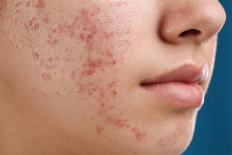 What Is Fungal Acne? - Causes & Treatments