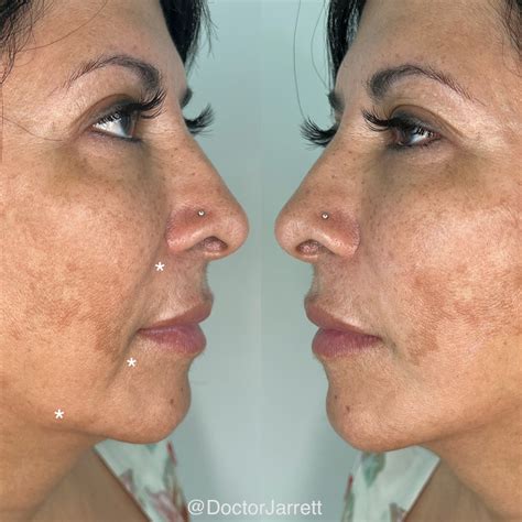 Nasolabial Folds Dermal Filler Treatment M1 Med Beauty Australia - sincerelystacey.blog