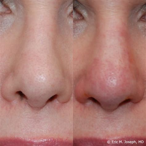 Eric M. Joseph, MD | Permanent Non-Surgical Rhinoplasty Before & After Photos
