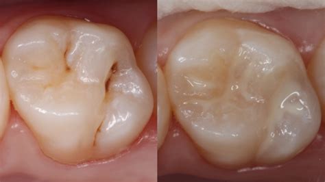 Dental Update - Are GIC sealants as effective as composite sealants in caries prevention?