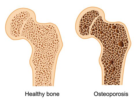 Osteoporosis: A Comprehensive Overview