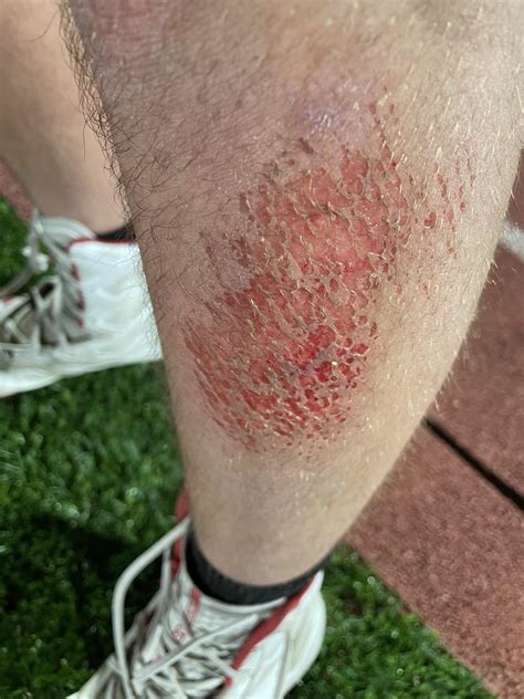 Will Turf Burn Scar at Allen Stark blog