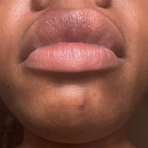 Reasons people get 'white bumps' on lips and other areas - Jongno1st