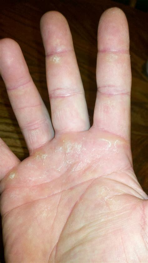 Hand Callus Pictures at Frank Keith blog