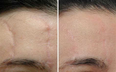 Scar Revision - Annapolis Plastic Surgery