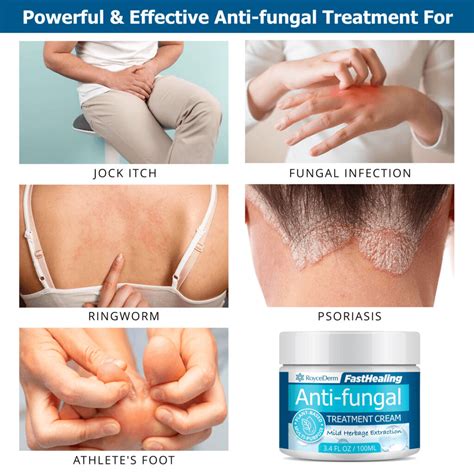 Anti-fungal Treatment Cream