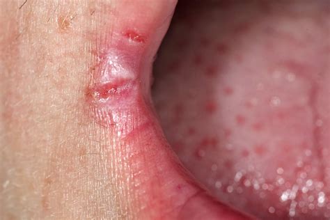 Canker Sores On Outside Of Lips