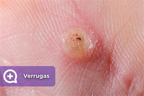 Porque Salen Las Verrugas