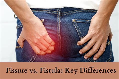 Fissure vs. Fistula: Key Differences | Dr. Abhijit Gotkhinde