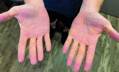 Florida Man’s Hands Filled with Cholesterol After Eating 6–9 Pounds of ...