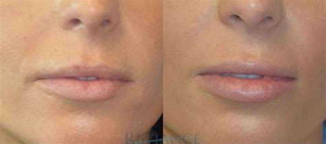 Lip Augmentation Implants & Injections Portland, Oregon – Réviance® Plastic Surgery & Aesthetic ...