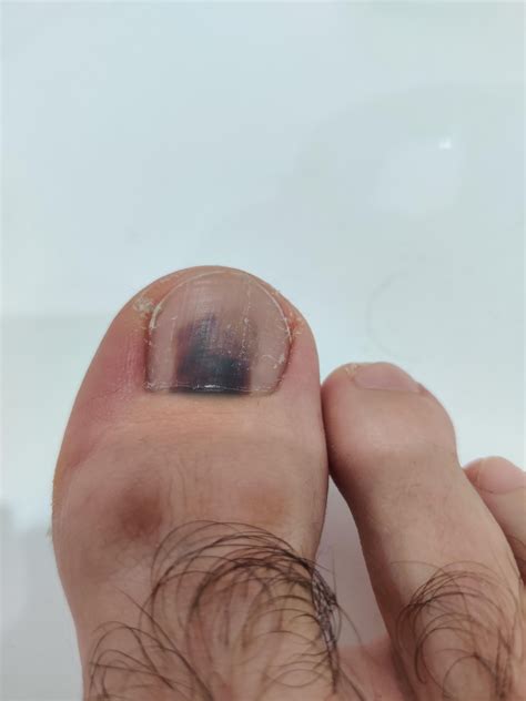 Toenail brow spot : r/Melanoma