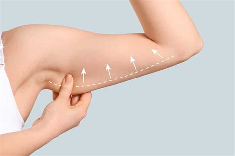 What Is BodyTite? How BodyTite Works? | Fat in under arms, How to get ...