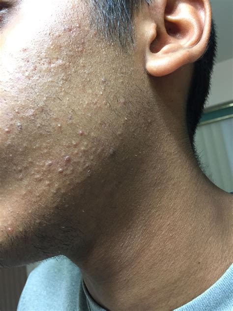 [skin concern] Small bumps on face mixed in with normal acne. Not sure if its acne, keratosis ...