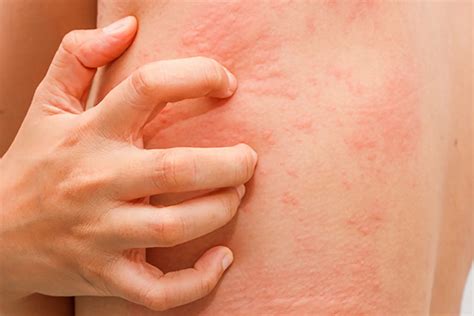 What is an Amoxicillin Rash? | LifeMD
