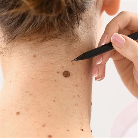 Skin Moles Removal Cost