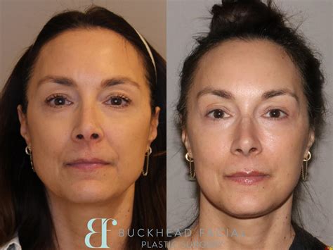 Face Contouring Surgery Before And After at Lilian Dixson blog