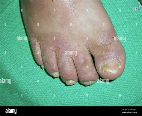 Athlete's foot infection. Athlete's foot, or tinea pedis, is a form of ringworm, a disease ...