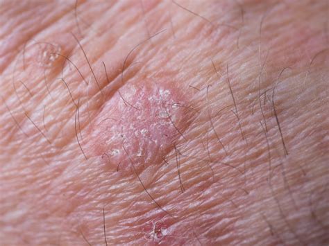Should Actinic Keratosis Be Removed? – Balmonds