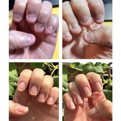This month marks 2 years making a conscious effort to stop biting my ...
