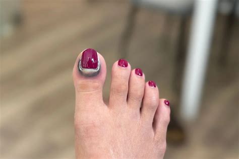 Understanding Nail Trauma | Straits Podiatry Singapore