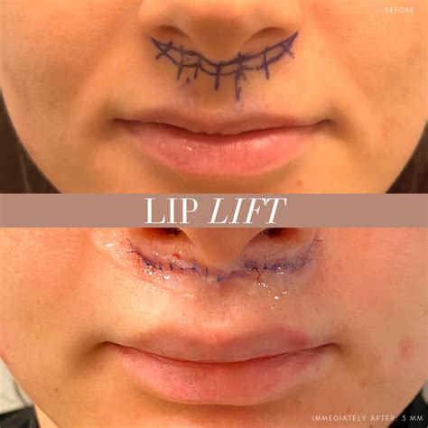 Lip lift surgery in norwalk connecticut serving stamford greenwich manhattan new york fairfield ...