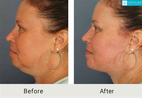 Lower Facelift and Neck Lift with Chin Implant - Carolina Facial Plastics