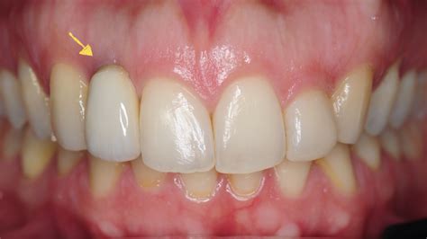 What Causes Brown Gums