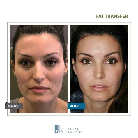 Fat Transfer - John Kang MD F.A.C.S :: JK Facial Plastics & Reconstructive