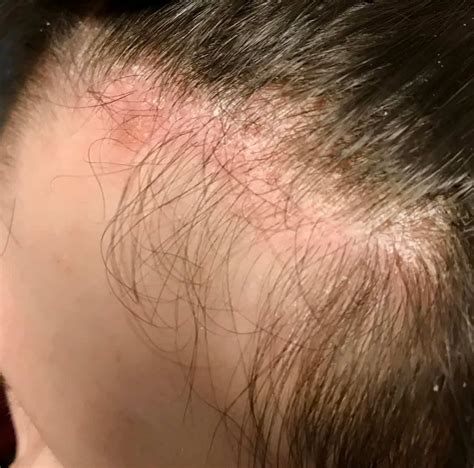Mild Scalp Psoriasis