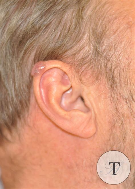 Melanoma Ear
