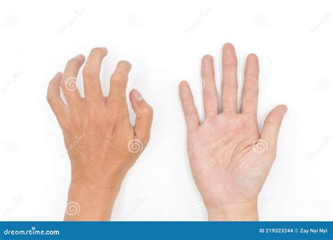 Hand Muscle Spasm in Asian Young Man. Unilateral Hand Deformity Stock ...