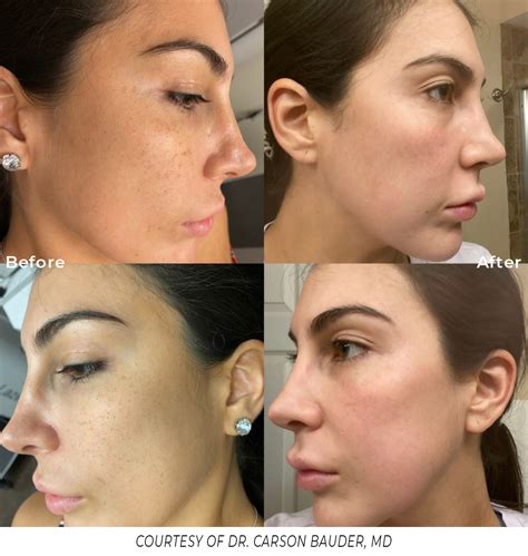 Erbium Laser Resurfacing | Scientiphika Medspa, Rhode Island