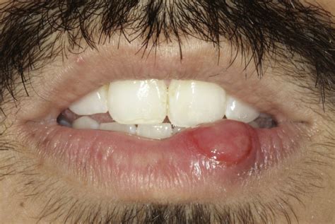Chronic ulcerative lesion of the lip - The Journal of the American Dental Association
