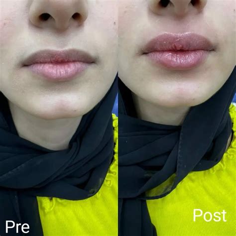 Lip augmentation in Hurghada - Book now - Nadara Center
