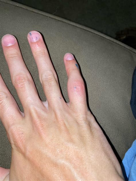 How do I go about treating my finger? : r/injuries