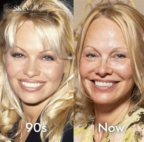 Pamela Anderson Face Surgery