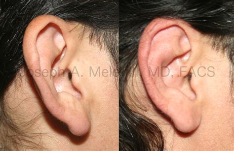 Cauliflower Ear Surgery Best Ear Surgery (Otoplasty) Raleigh, NC