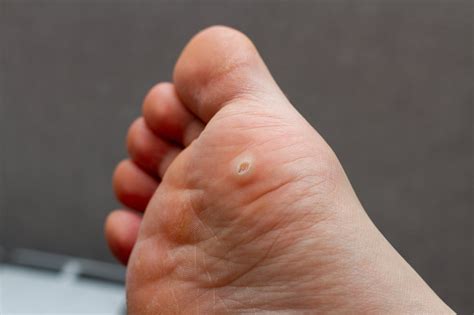 Mosaic Wart