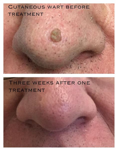 Wart Removal Treatments in Middlewich, Cheshire