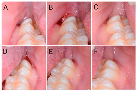 Comparison between the Flapless Surgical Approach and a Novel Single Incision Access in Terms of ...