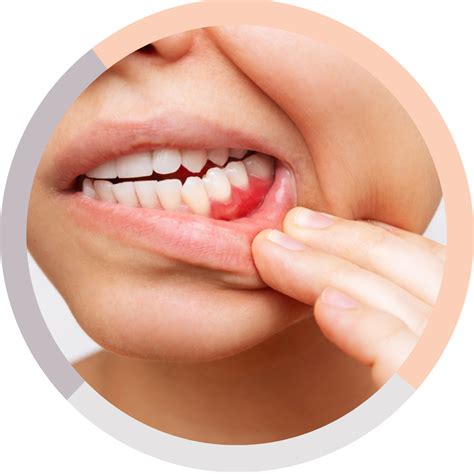 Bleeding/Swollen Gums - What to do Next? Melbourne Dentist in Malvern East