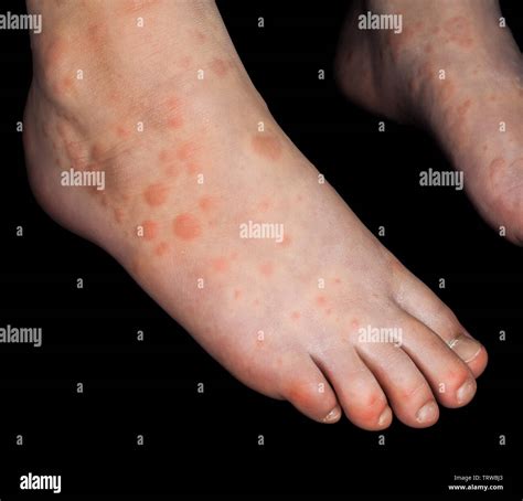 Why Do I Have A Rash In My Feet at Kiara Victor blog