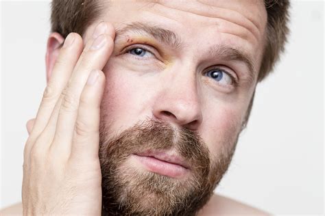 What Do Your Eyes Look Like When You Have a Concussion?