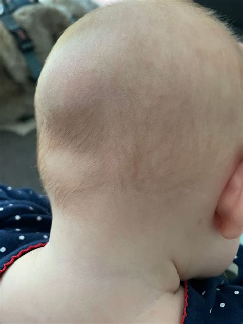 Weird head shape? *pic* | BabyCenter