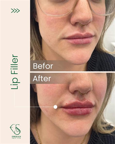 Lip Fillers Before & After Photos | Emerald Skin Lab | Toronto