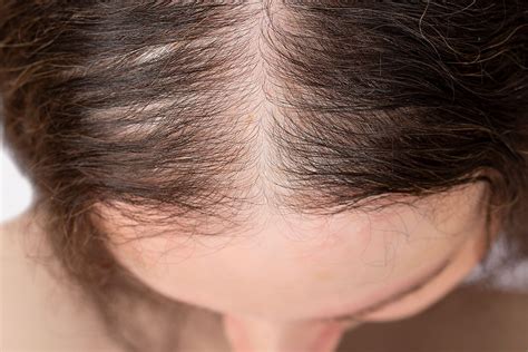 Hair Thinning | Colorado Dermatology Institute