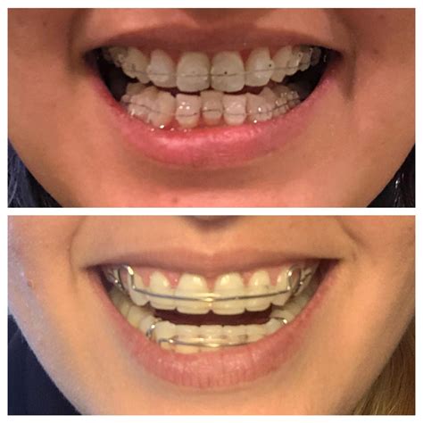 Retainers After Braces