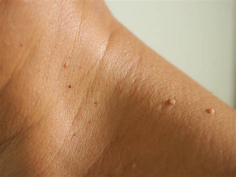 What Are Skin Tags & How To Get Rid Of Them? | Bodyvie